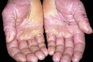 Da bị dị ứng với dầu cắt gọt kim loại pha nước